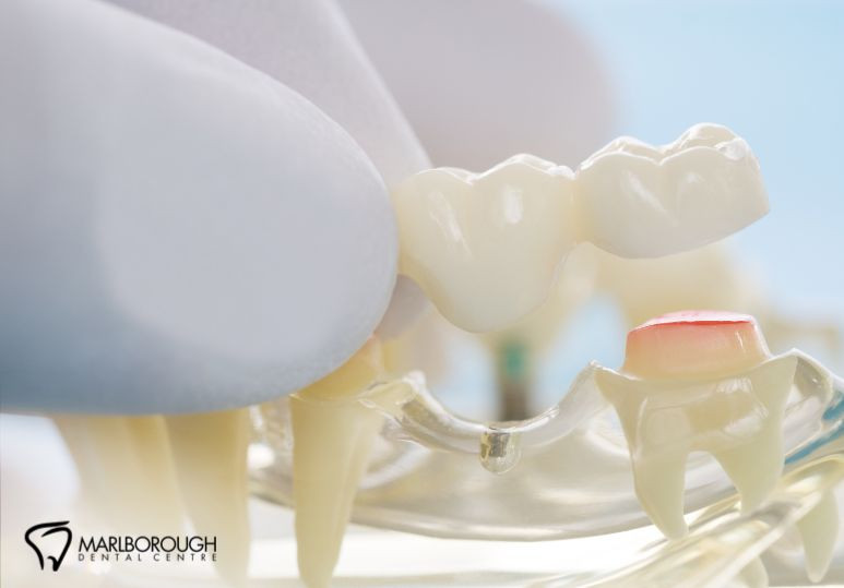 Calgary Dental Bridges: 5 Reasons Why They Are an Excellent Solution for Missing Teeth